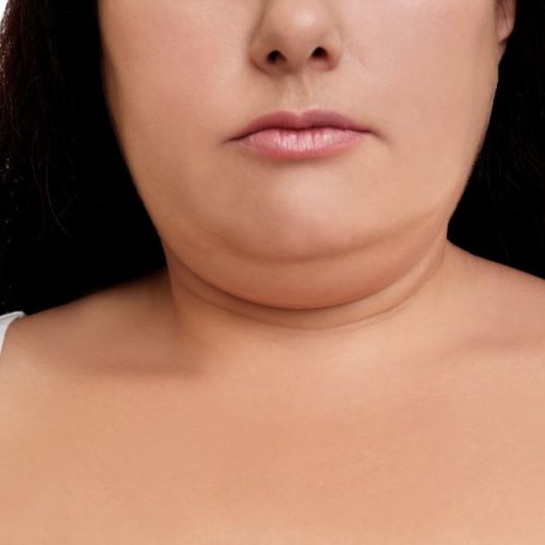 double chin liposuction, double chin removal 